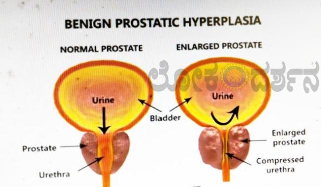 ಹಿರಿಯರಲ್ಲಿ ಪ್ರೋಸ್ಟೇಟ್ ಗ್ರಂಥಿ ಹಿಗ್ಗುವಿಕೆ ಅರಿವು ಜಾಗೃತಿ  
