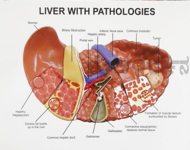 ಪ್ರಪಂಚಕ್ಕೆ ಸವಾಲಾಗಿರುವ ಹೆಪಟೈಟಿಸ್ ಬಿ ವೈರಸ್ 