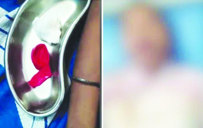 ಗಂಟಲಲ್ಲಿ ಬಲೂನ್ ಸಿಲುಕಿ ಬಾಲಕ ಸಾವು