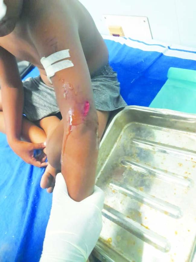 ಮಕ್ಕಳಿಗೆ ಹುಚ್ಚು ನಾಯಿ ಕಡಿದು ಗಾಯ