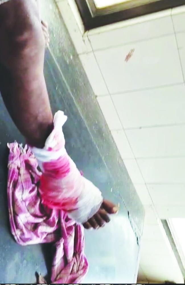 ಸ್ನಾನಕ್ಕೆ ನದಿಗೆ ಹೋದ ವ್ಯಕ್ತಿಯ ಮೇಲೆ ಮೊಸಳೆ ದಾಳಿ: ಗಂಭೀರ ಗಾಯ 