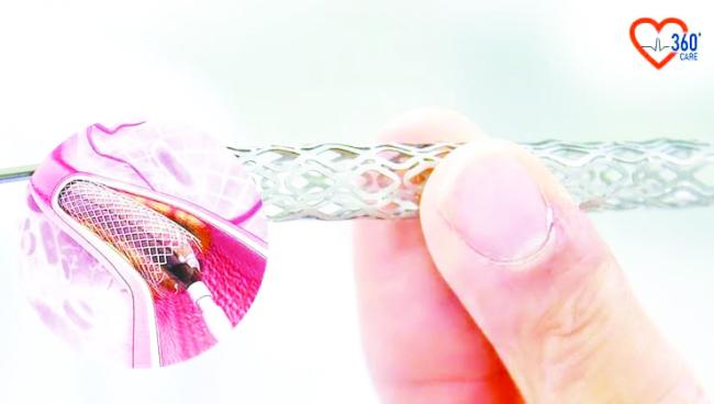 ಭಾರತದಲ್ಲಿ ತಯಾರಾದ ಹೃದಯ ಸ್ಟೆಂಟ್ಗೆ ಜಾಗತಿಕ ಮನ್ನಣೆ 