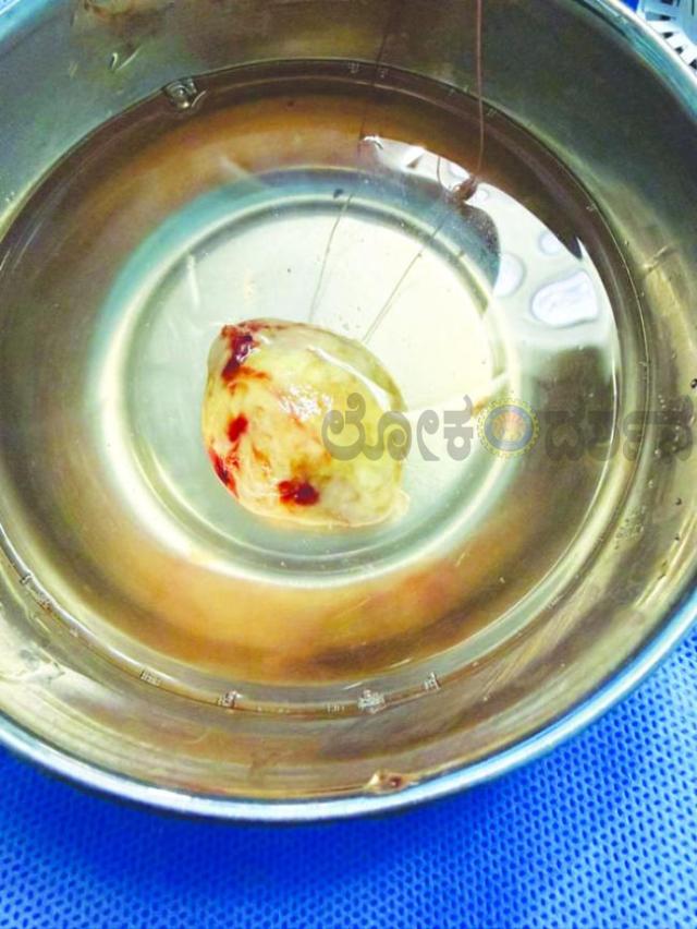 ಹೃದಯದಲ್ಲಿನ ಗಡ್ಡೆ: ಡಾ. ರವಿ ಘಟ್ನಟ್ಟಿ ತಂಡದಿಂದ ಕೀಹೋಲ್ ಯಶಸ್ವಿ ಶಸ್ತ್ರ ಚಿಕಿತ್ಸೆ